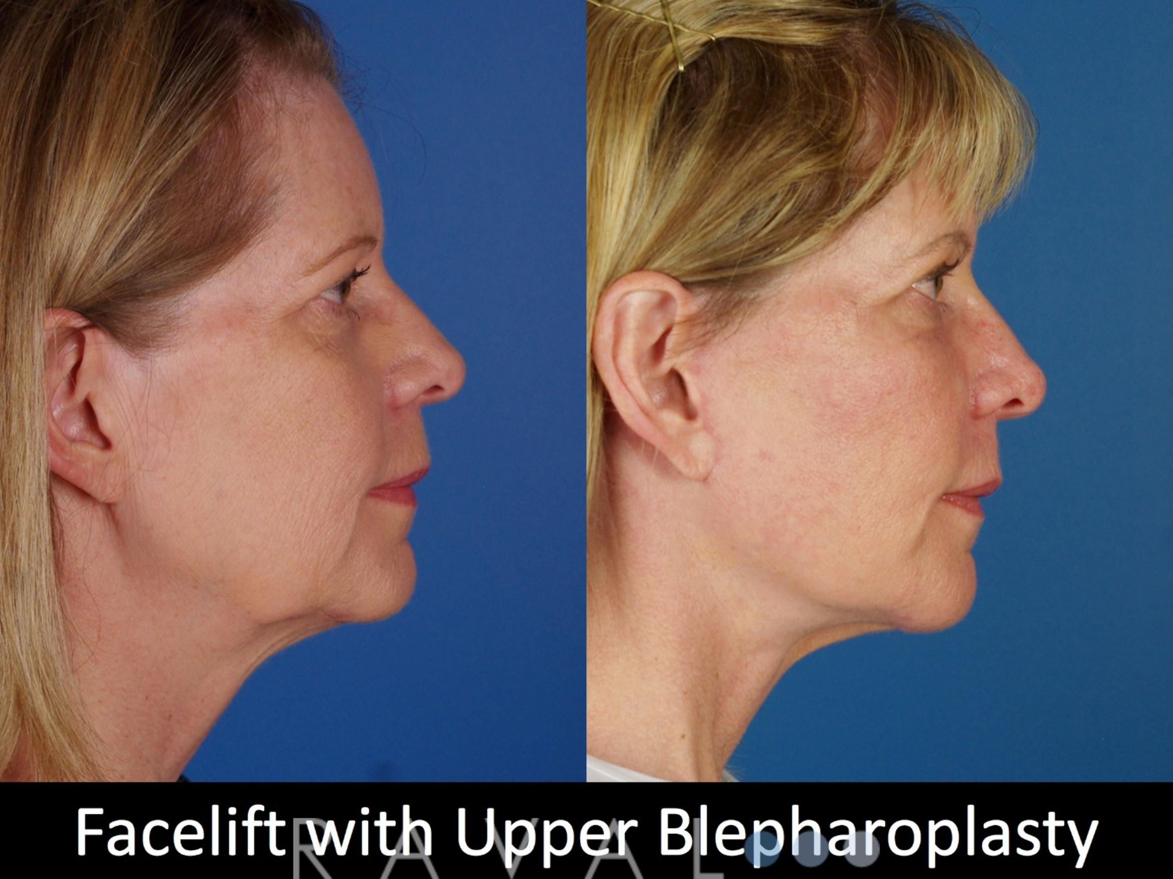 Before & After Eyelid Lifts Case 1068 View 3 View in Denver, CO