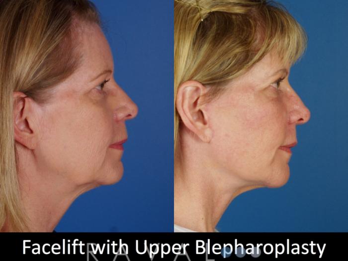 Before & After Eyelid Lifts Case 1068 View 3 View in Denver, CO