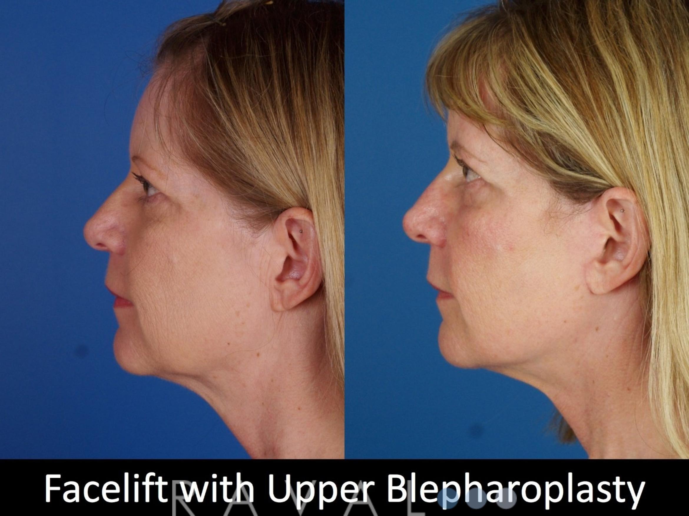 Before & After Eyelid Lifts Case 1068 View 4 View in Denver, CO