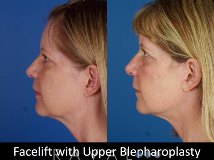 Before & After Eyelid Lifts Case 1068 View 4 View in Denver, CO