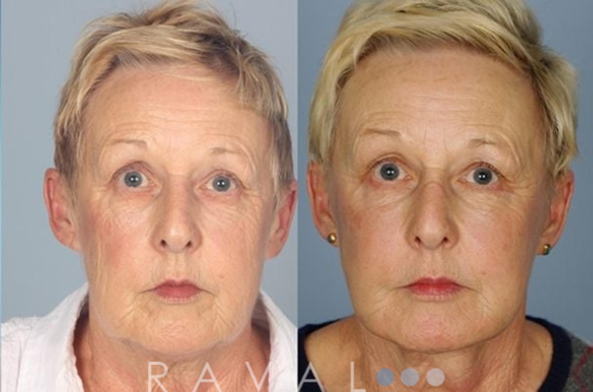 Before & After Facelifts & Neck Lifts Case 1070 View 1 View in Denver, CO