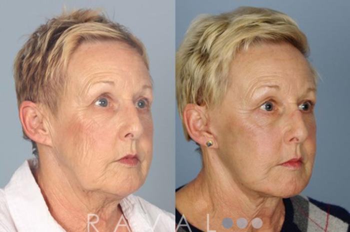 Before & After Facelifts & Neck Lifts Case 1070 View 2 View in Denver, CO