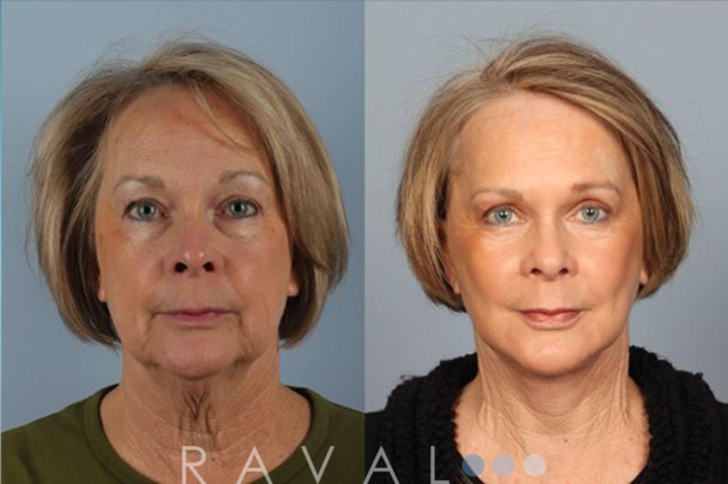 Before & After Facelifts & Neck Lifts Case 1071 View 1 View in Denver, CO