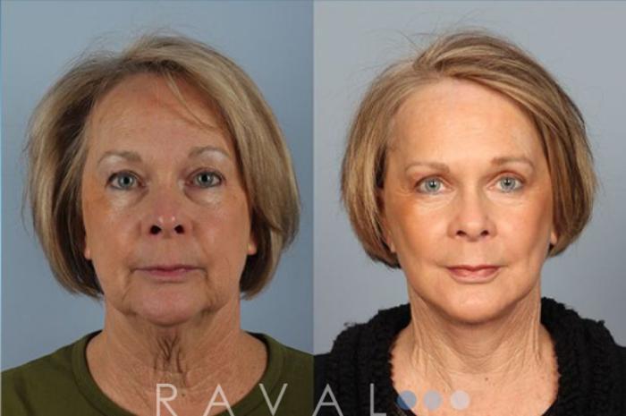 Before & After Facelifts & Neck Lifts Case 1071 View 1 View in Denver, CO