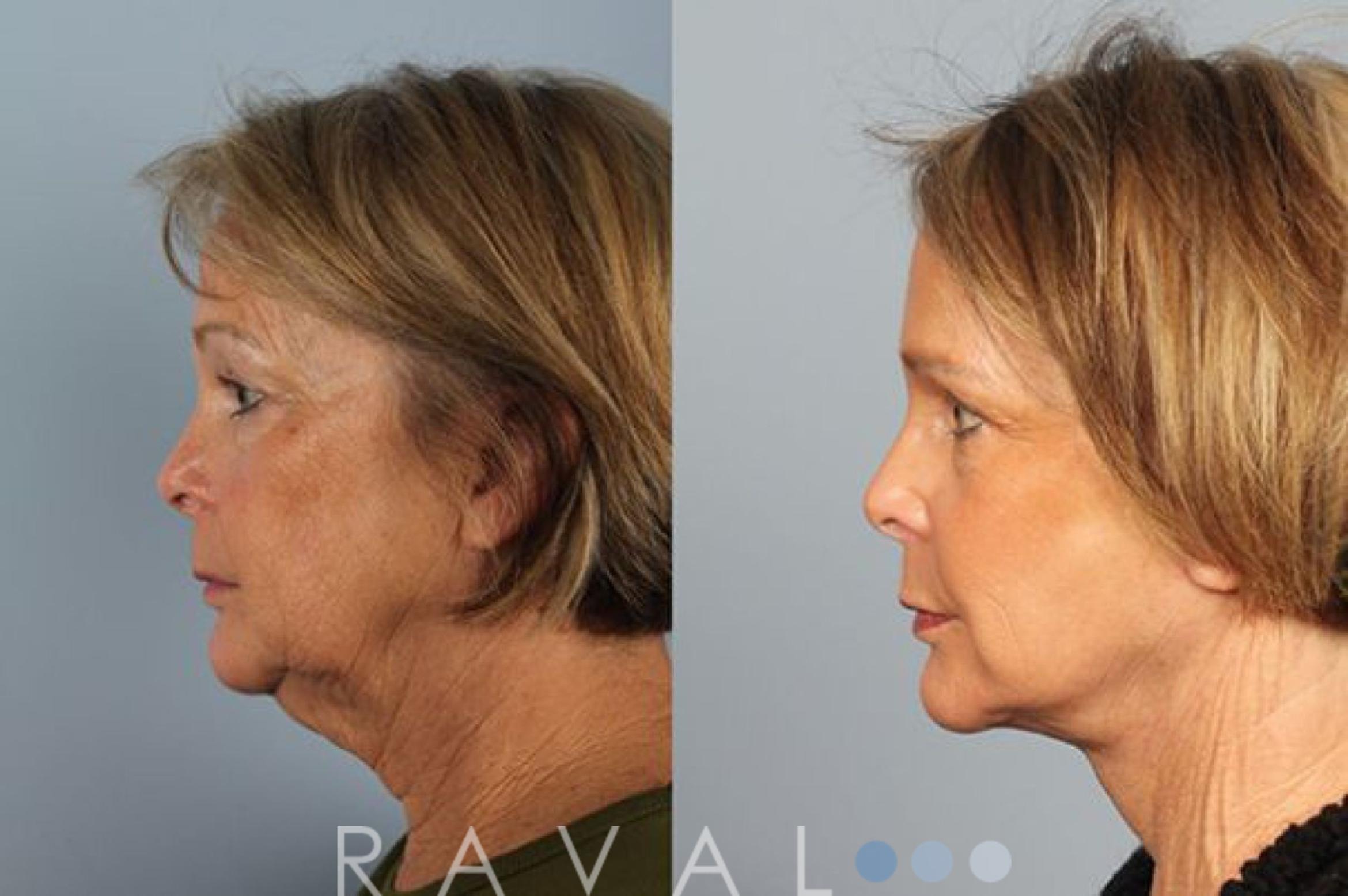 Before & After Facelifts & Neck Lifts Case 1071 View 2 View in Denver, CO