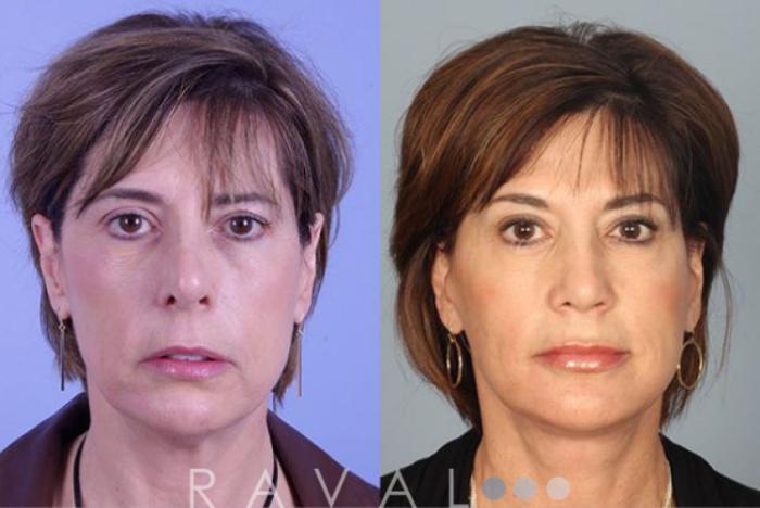 Before & After Facelifts & Neck Lifts Case 1072 View 1 View in Denver, CO