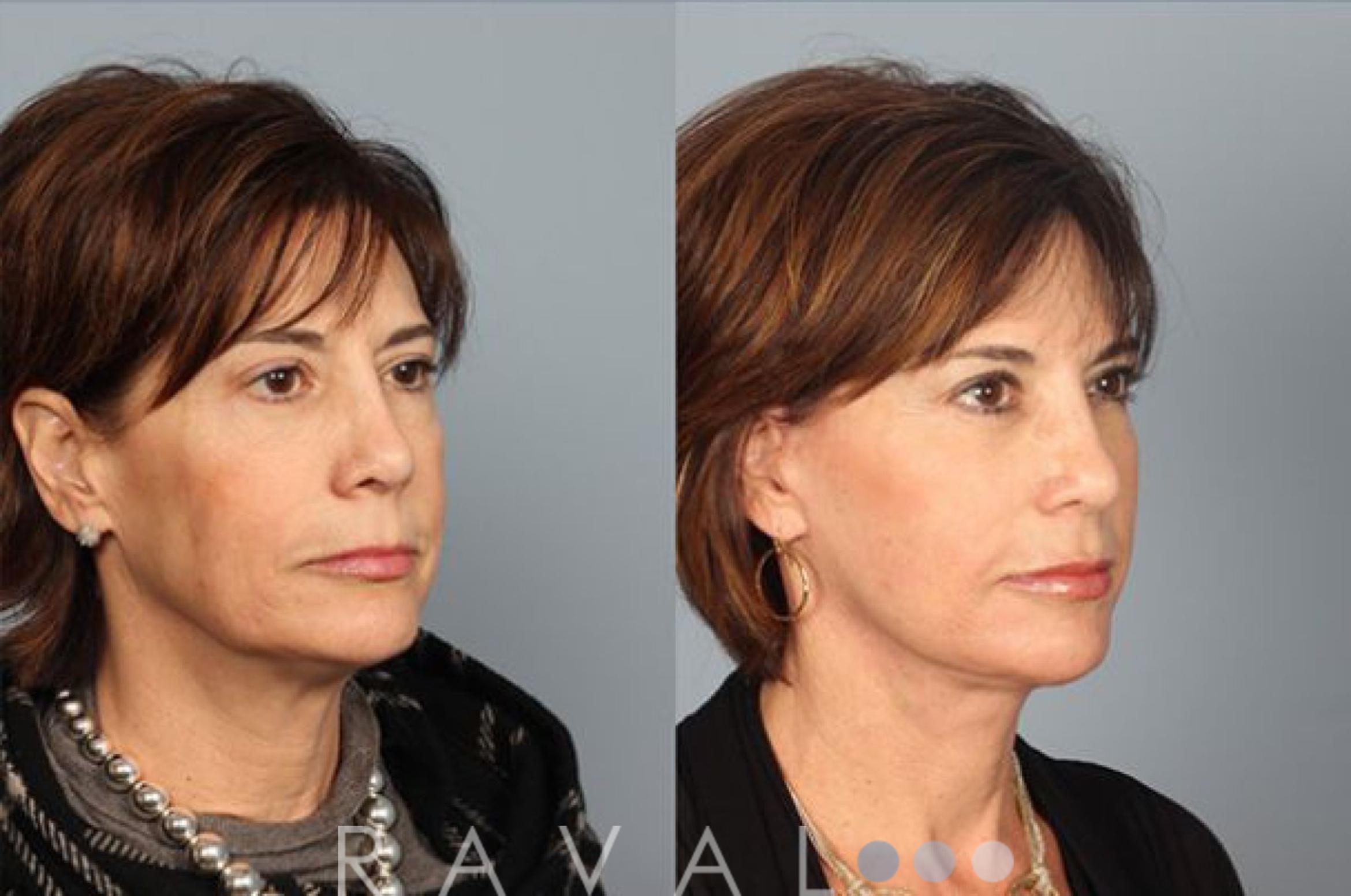 Before & After Facelifts & Neck Lifts Case 1072 View 2 View in Denver, CO