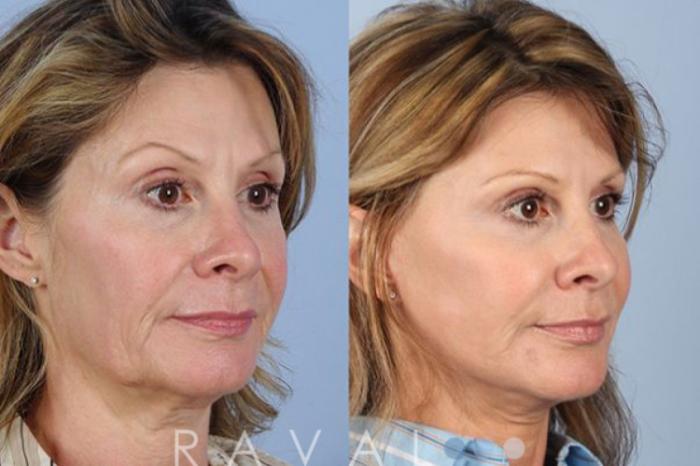 Before & After Facelifts & Neck Lifts Case 1073 View 1 View in Denver, CO