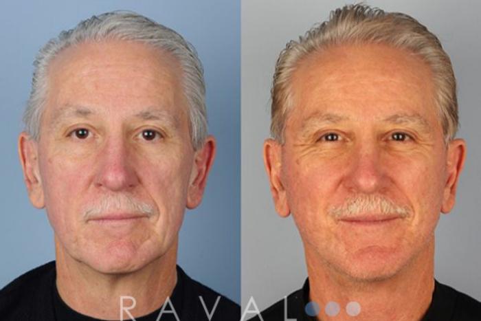 Before & After Facelifts & Neck Lifts Case 1074 View 1 View in Denver, CO