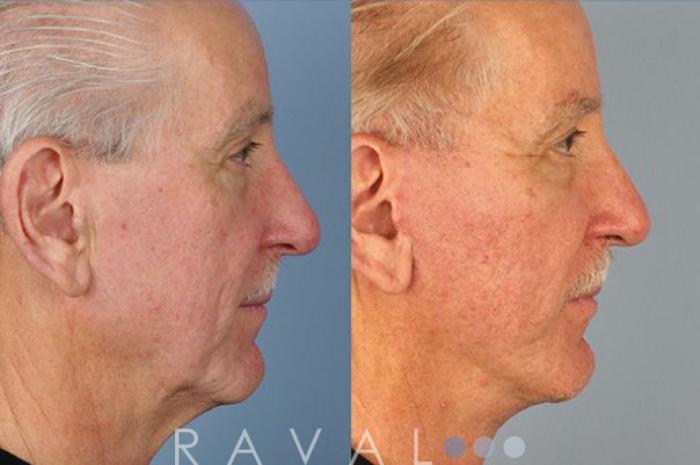 Before & After Facelifts & Neck Lifts Case 1074 View 2 View in Denver, CO