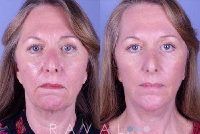 Before & After Facelifts & Neck Lifts Case 1075 View 1 View in Denver, CO