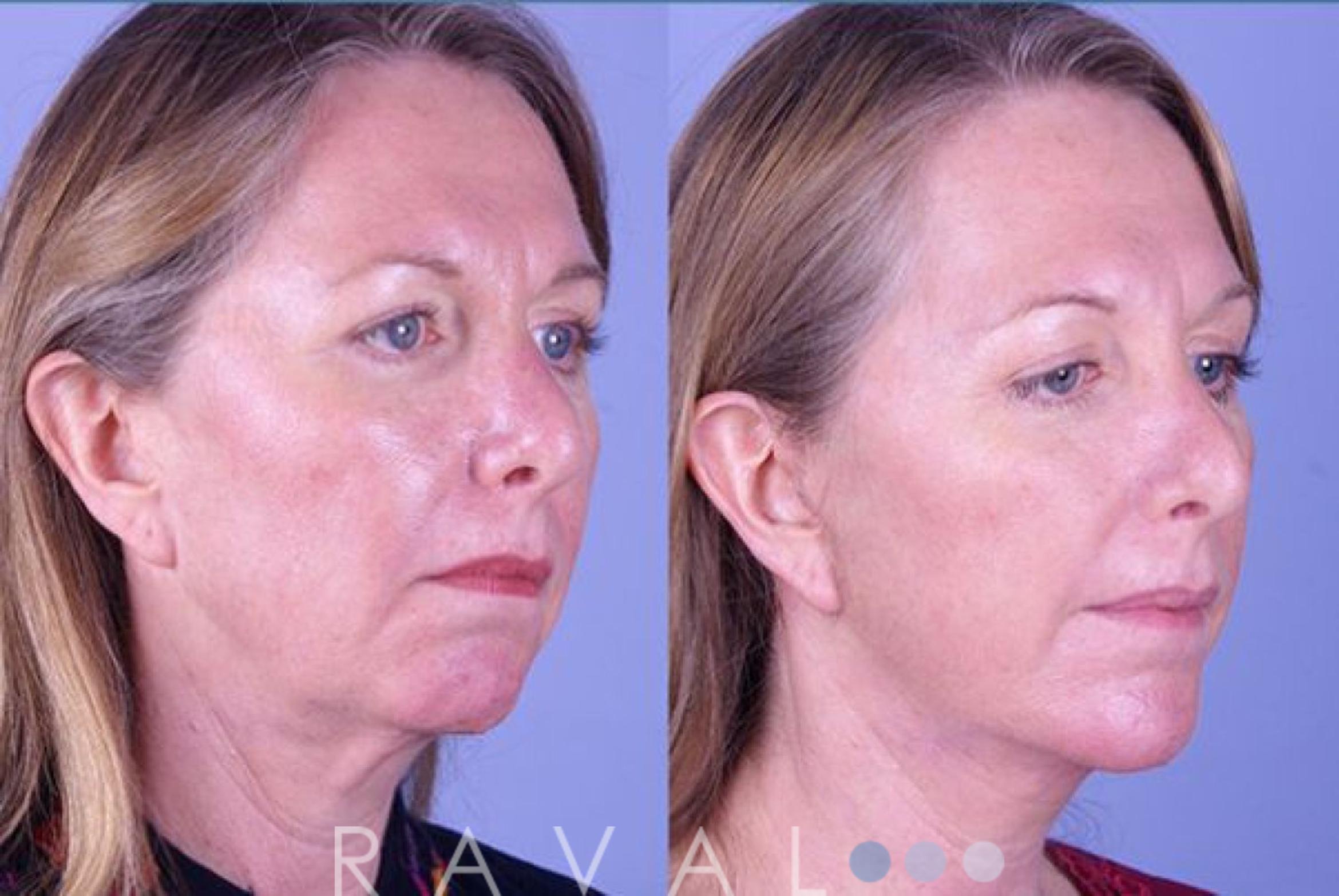 Before & After Facelifts & Neck Lifts Case 1075 View 2 View in Denver, CO