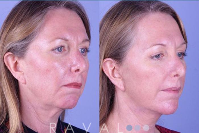 Before & After Facelifts & Neck Lifts Case 1075 View 2 View in Denver, CO