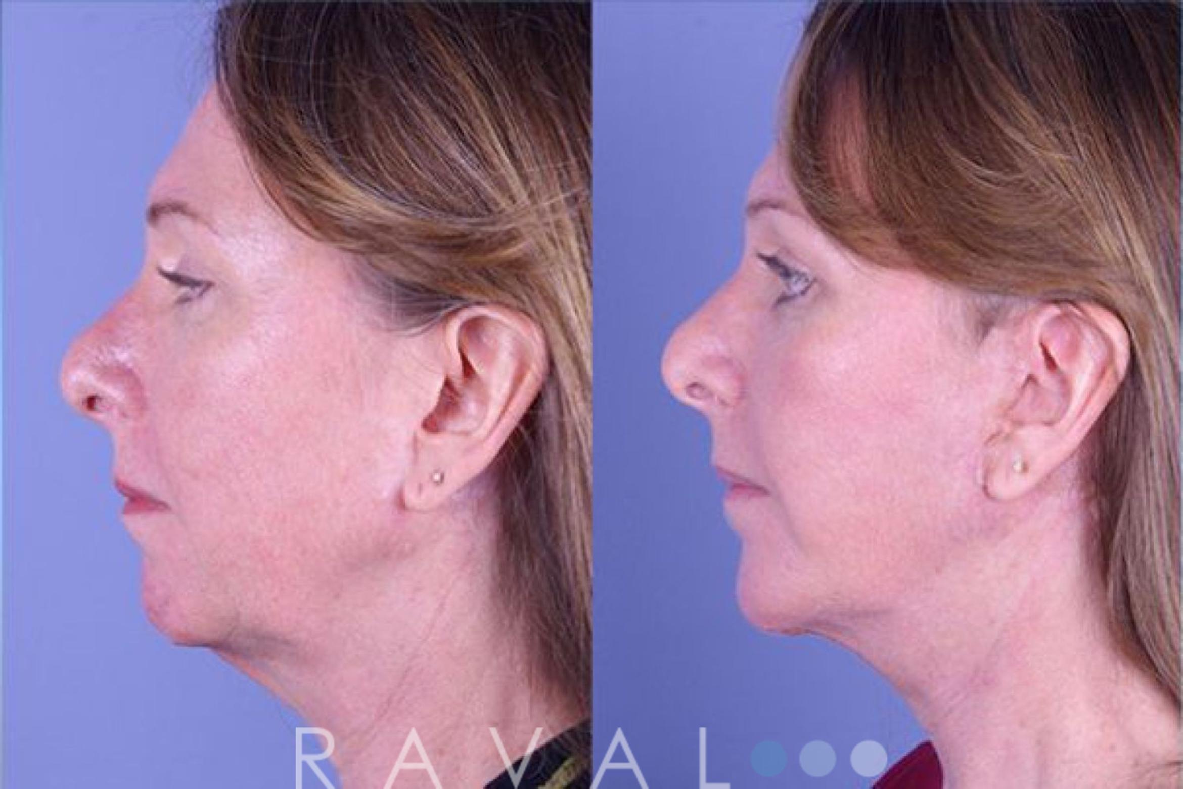 Before & After Facelifts & Neck Lifts Case 1075 View 3 View in Denver, CO