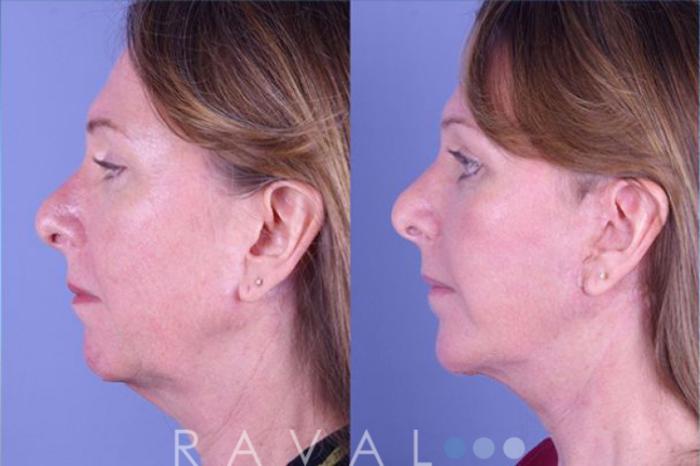 Before & After Facelifts & Neck Lifts Case 1075 View 3 View in Denver, CO