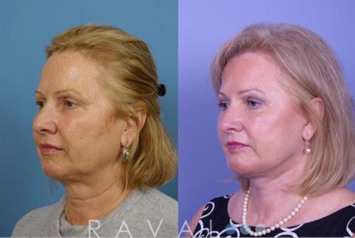 Before & After Facelifts & Neck Lifts Case 1076 View 1 View in Denver, CO