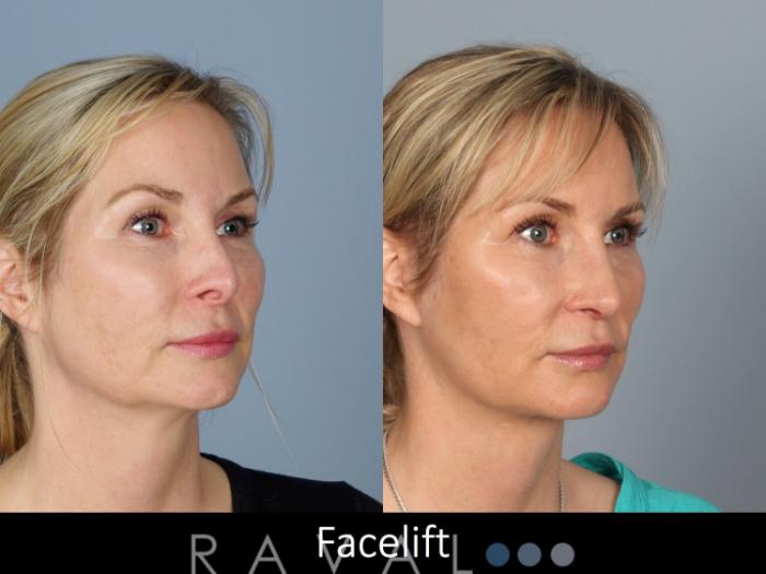 Before & After Facelifts & Neck Lifts Case 1077 View 1 View in Denver, CO