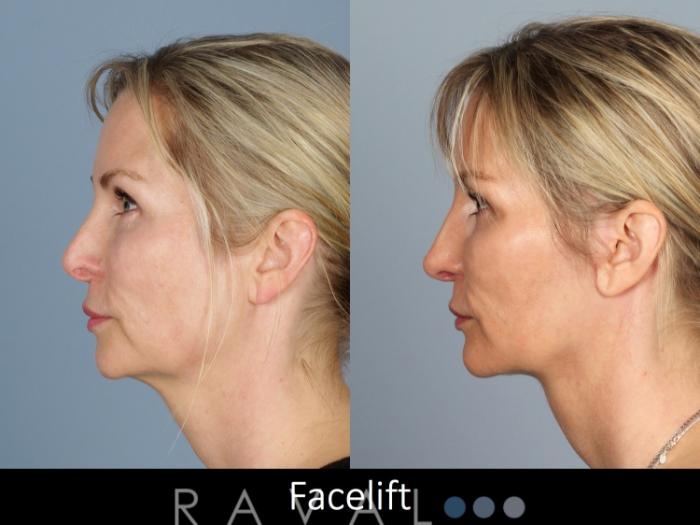 Before & After Facelifts & Neck Lifts Case 1077 View 2 View in Denver, CO