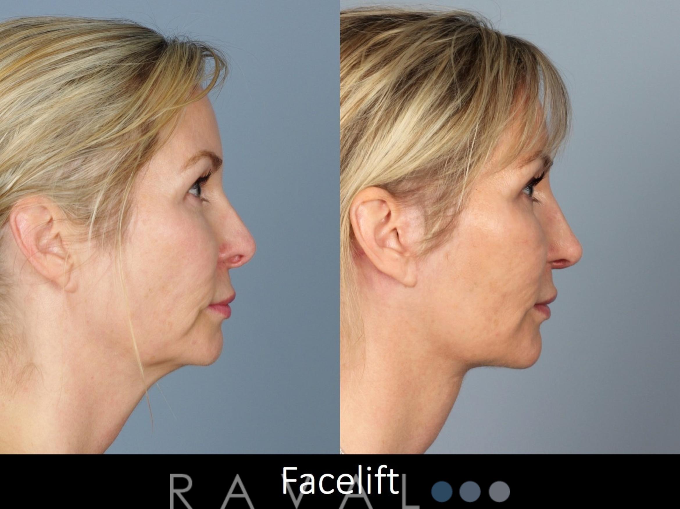 Before & After Facelifts & Neck Lifts Case 1077 View 3 View in Denver, CO
