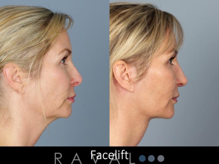 Before & After Facelifts & Neck Lifts Case 1077 View 3 View in Denver, CO