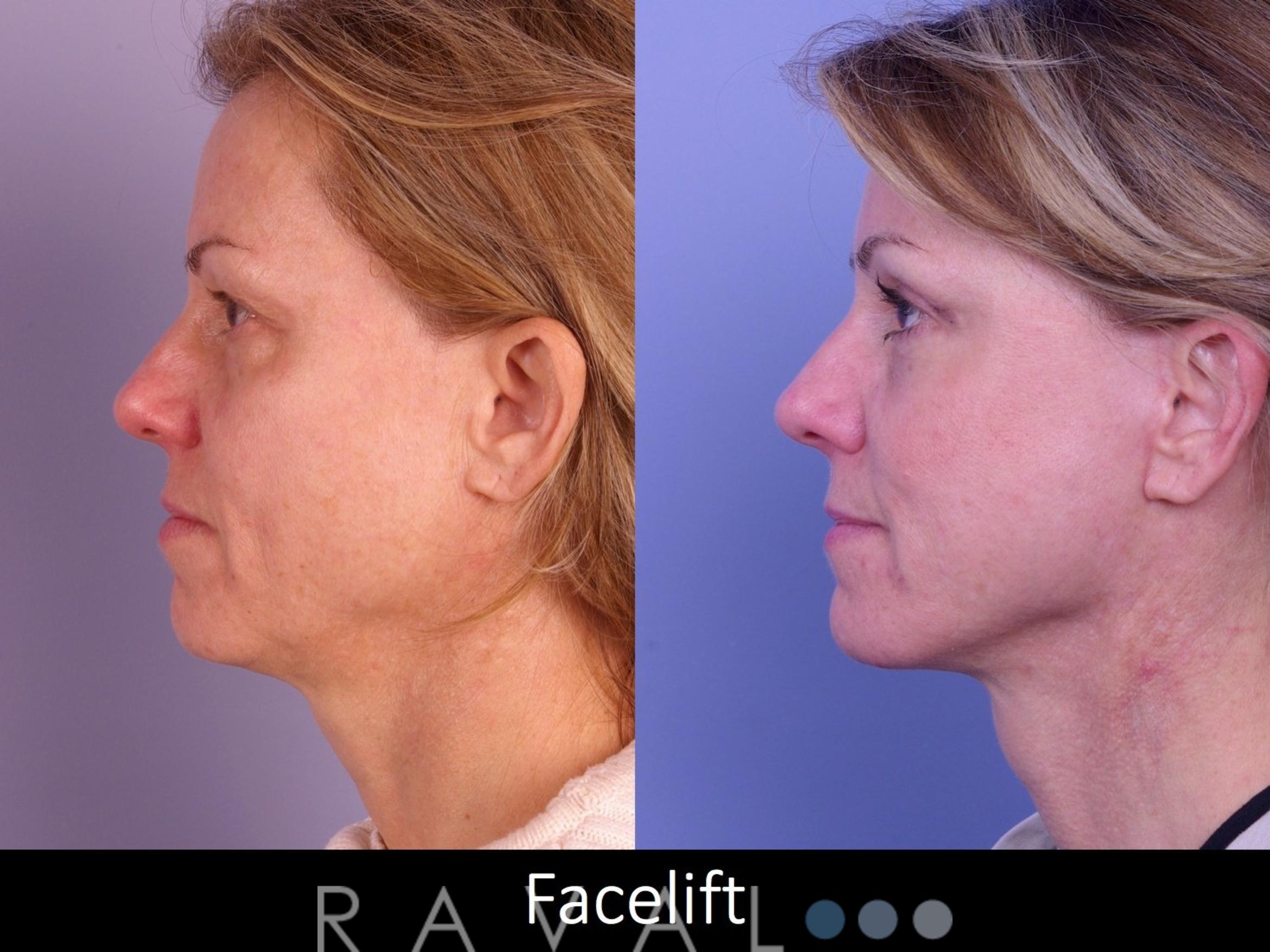 Before & After Facelifts & Neck Lifts Case 1078 View 1 View in Denver, CO