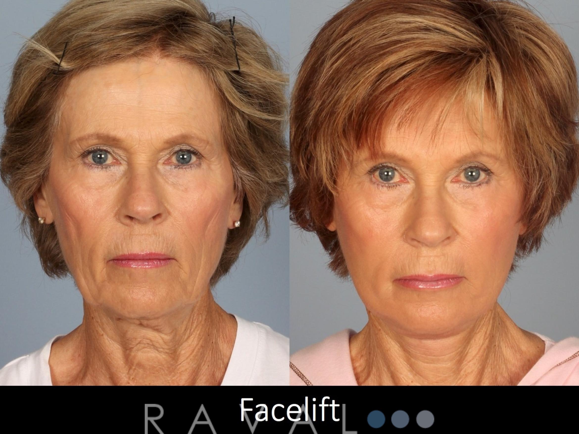 Before & After Facelifts & Neck Lifts Case 1079 View 2 View in Denver, CO