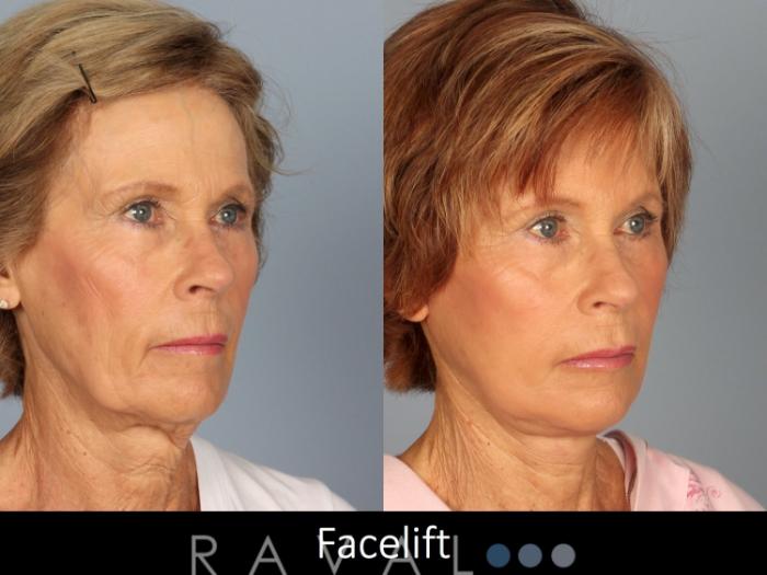 Before & After Facelifts & Neck Lifts Case 1079 View 3 View in Denver, CO