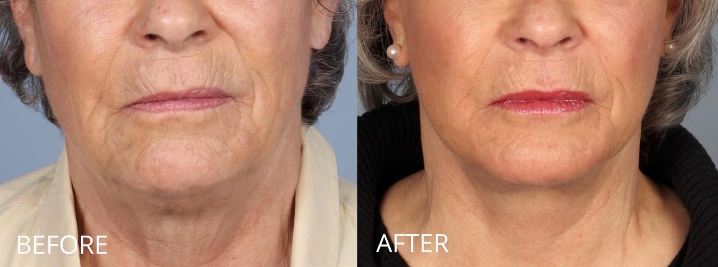 Before & After Facelifts & Neck Lifts Case 1080 View 1 View in Denver, CO