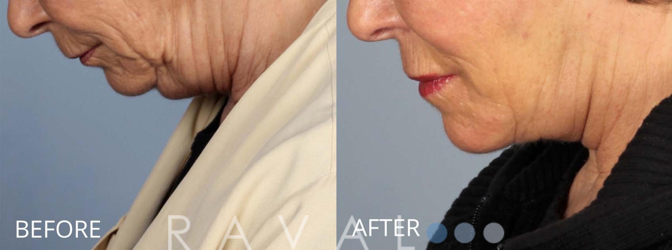 Before & After Facelifts & Neck Lifts Case 1080 View 2 View in Denver, CO