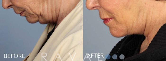 Before & After Facelifts & Neck Lifts Case 1080 View 2 View in Denver, CO