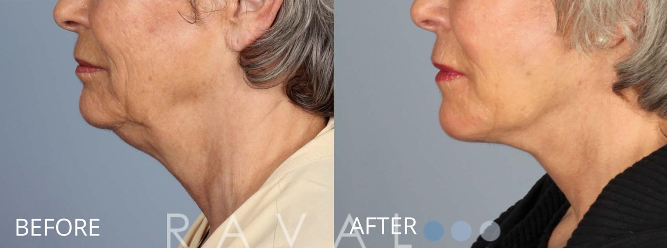 Before & After Facelifts & Neck Lifts Case 1080 View 3 View in Denver, CO