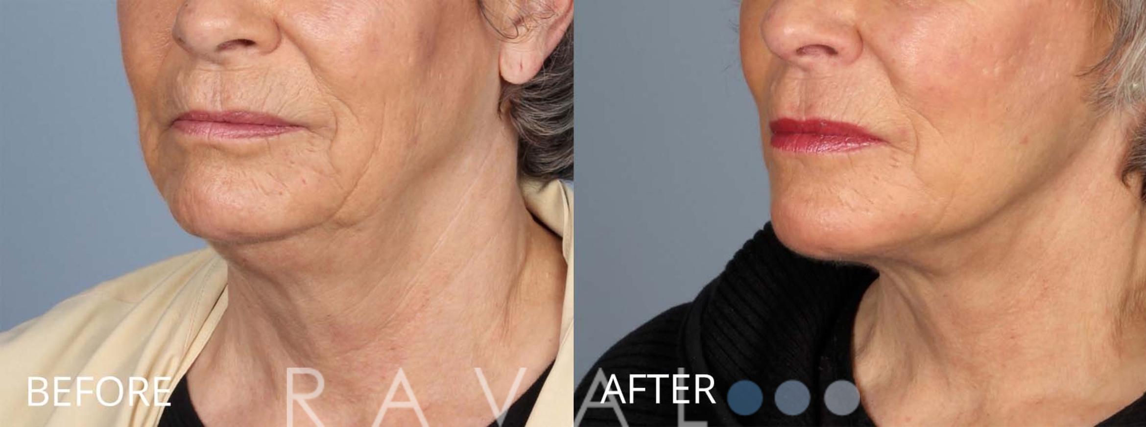 Before & After Facelifts & Neck Lifts Case 1080 View 4 View in Denver, CO