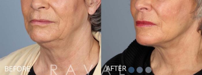 Before & After Facelifts & Neck Lifts Case 1080 View 4 View in Denver, CO