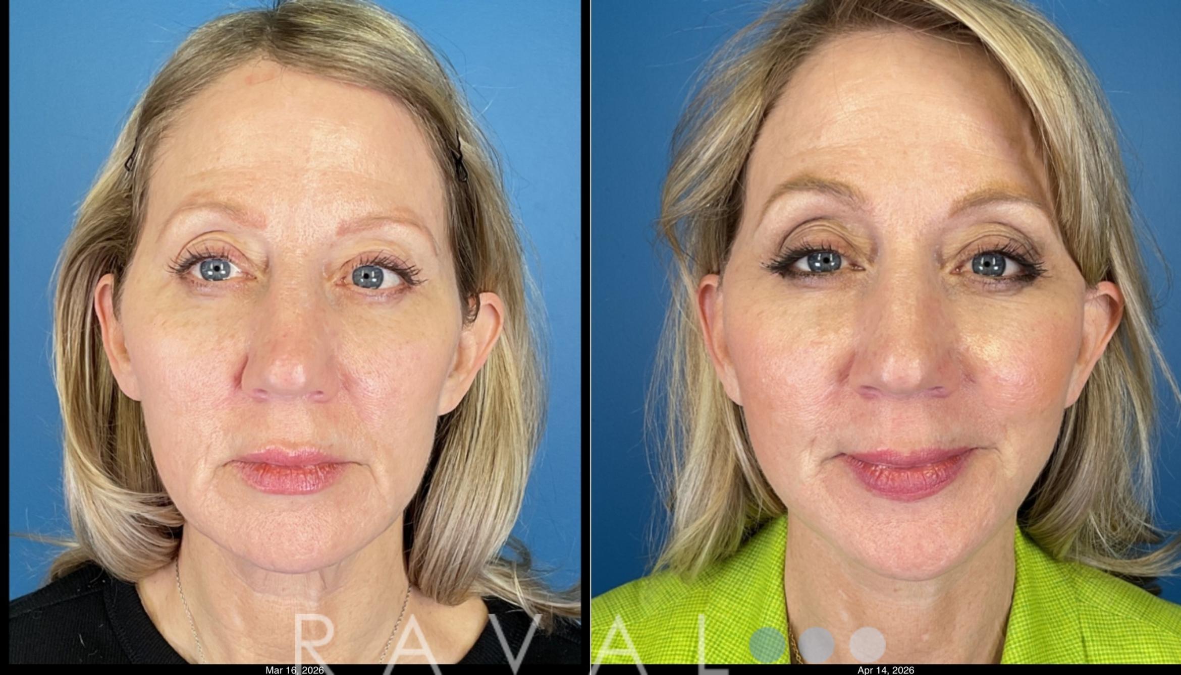 Before & After Facelifts & Neck Lifts Case 1204 Front View in Denver, CO