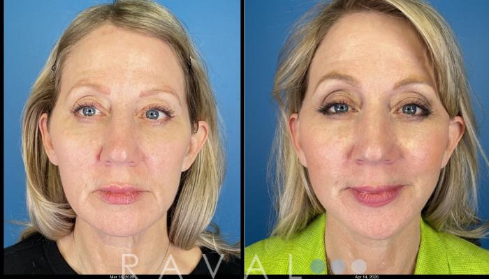 Before & After Facelifts & Neck Lifts Case 1204 Front View in Denver, CO