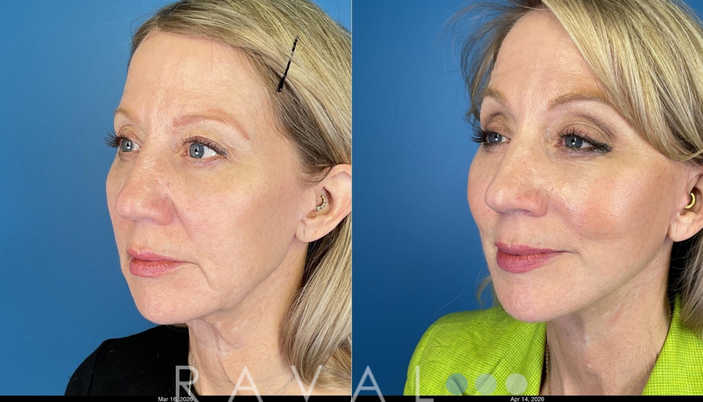 Before & After Facelifts & Neck Lifts Case 1204 Left Oblique View in Denver, CO