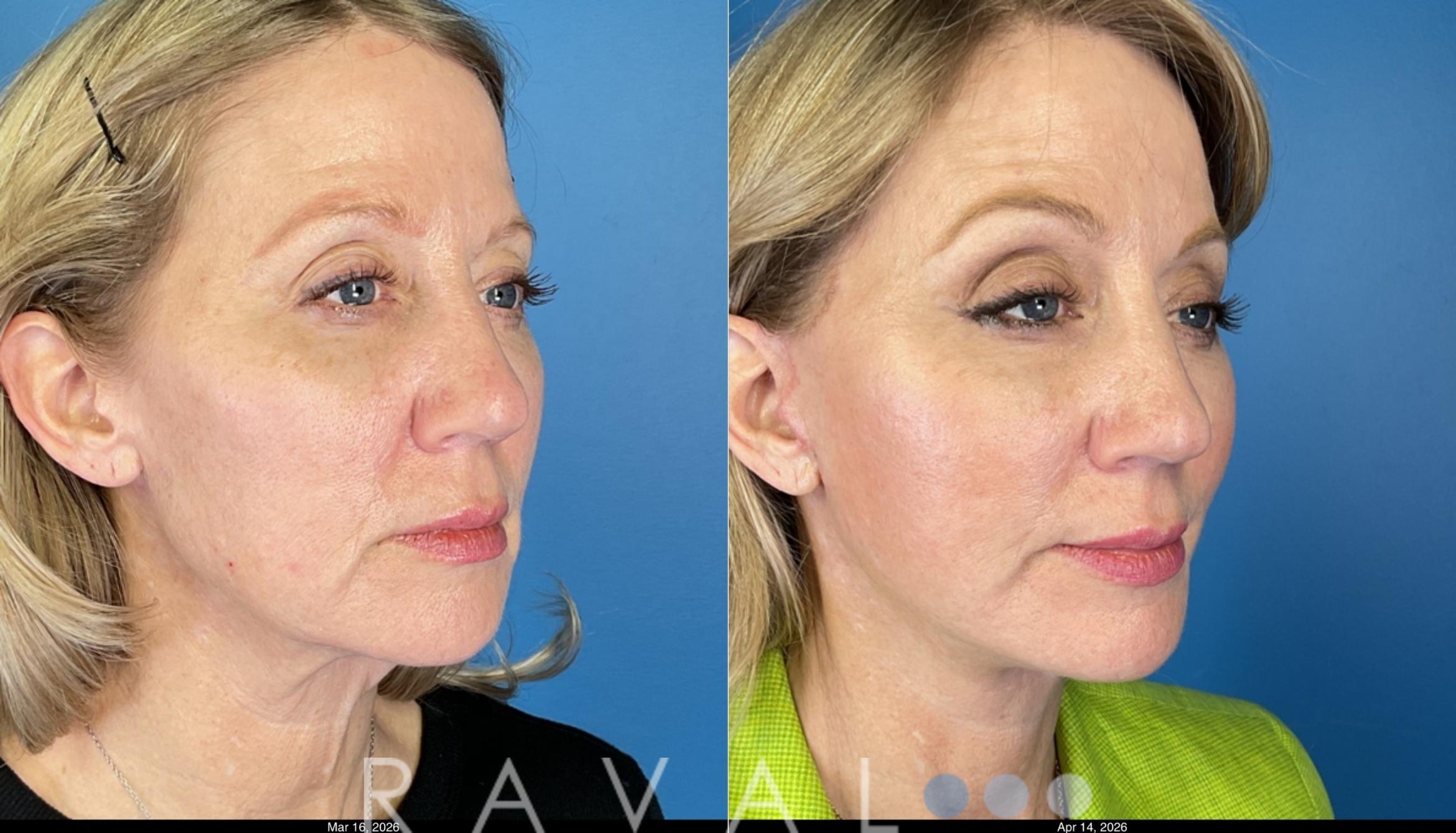 Before & After Facelifts & Neck Lifts Case 1204 Right Oblique View in Denver, CO