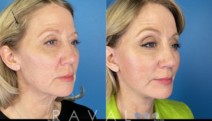Before & After Facelifts & Neck Lifts Case 1204 Right Oblique View in Denver, CO