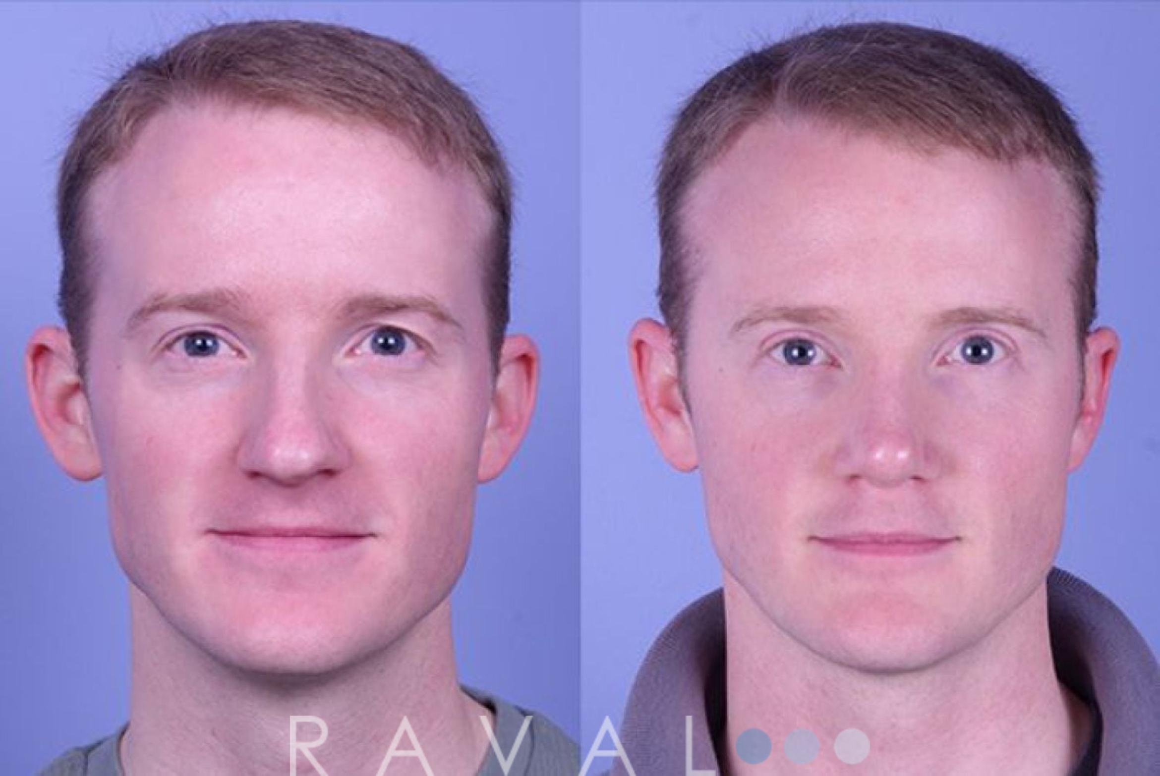 Before & After Otoplasty Case 1081 View 1 View in Denver, CO