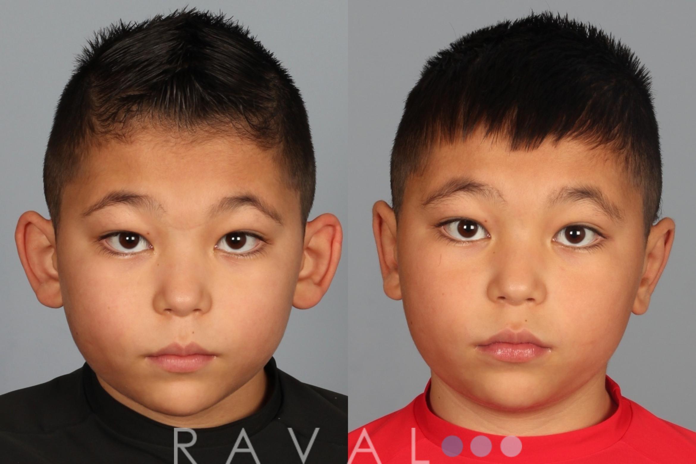 Before & After Otoplasty Case 1083 View 1 View in Denver, CO