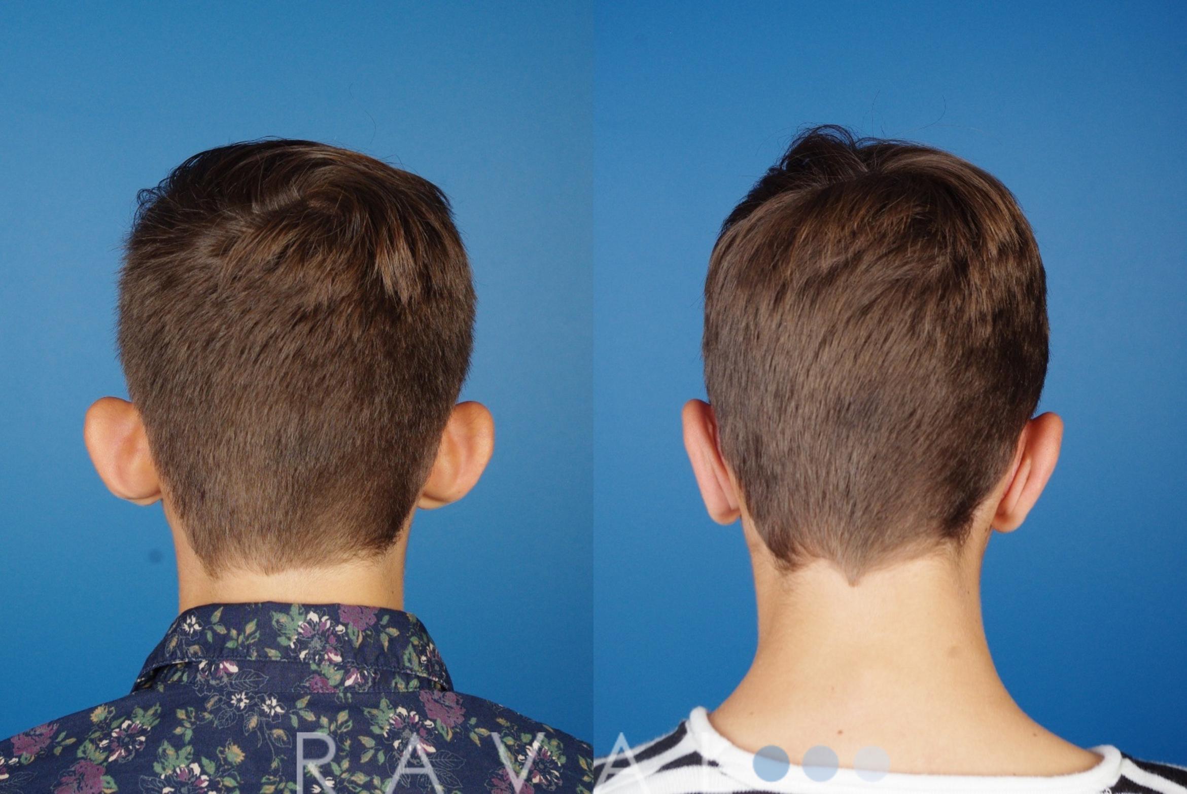 Before & After Otoplasty Case 1084 View 2 View in Denver, CO