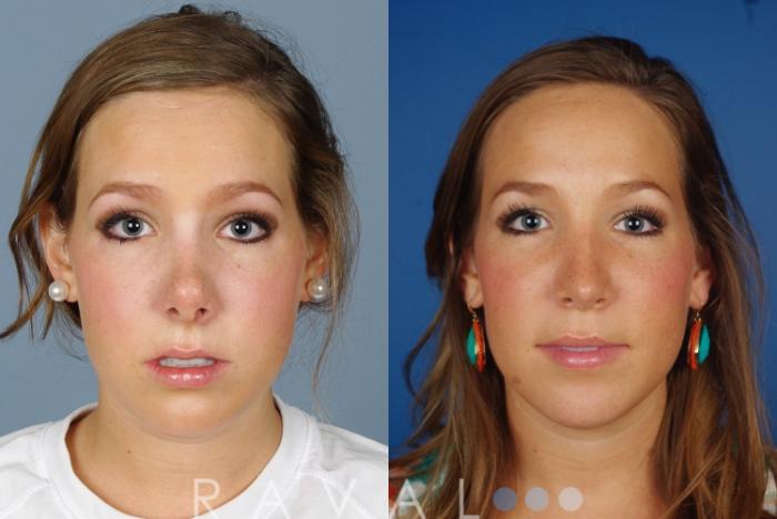 Before & After Revision Rhinoplasty Case 1045 View 1 View in Denver, CO