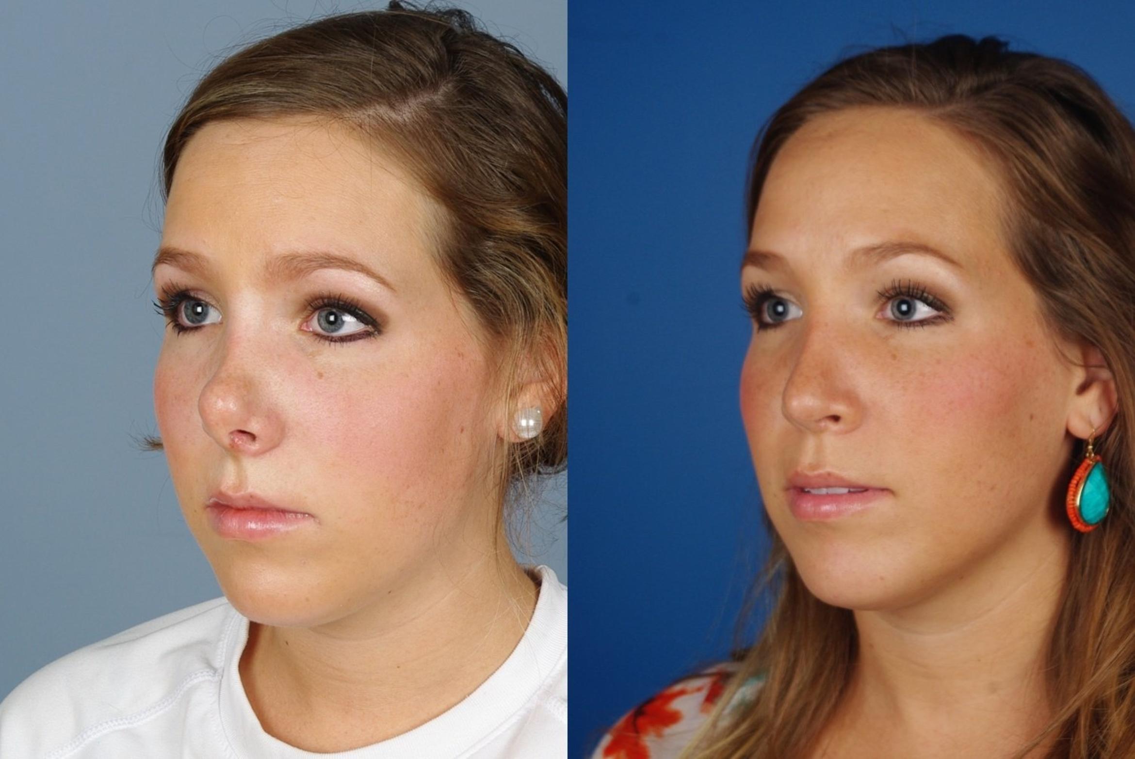 Before & After Revision Rhinoplasty Case 1045 View 2 View in Denver, CO
