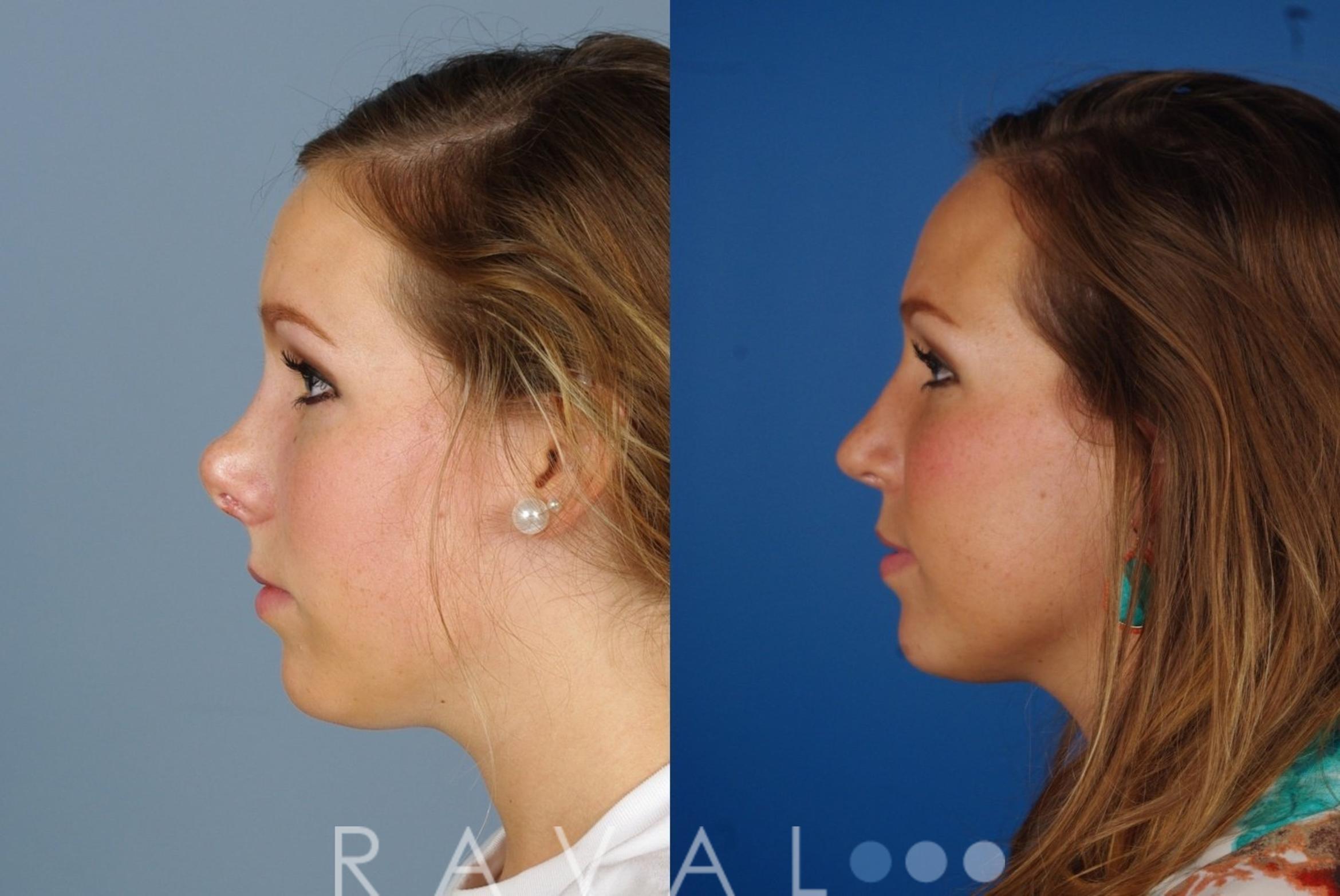 Before & After Revision Rhinoplasty Case 1045 View 3 View in Denver, CO