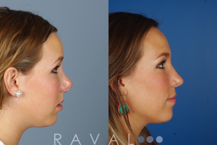 Before & After Revision Rhinoplasty Case 1045 View 4 View in Denver, CO