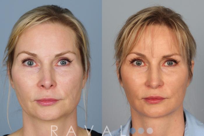 Before & After Revision Rhinoplasty Case 1046 View 1 View in Denver, CO