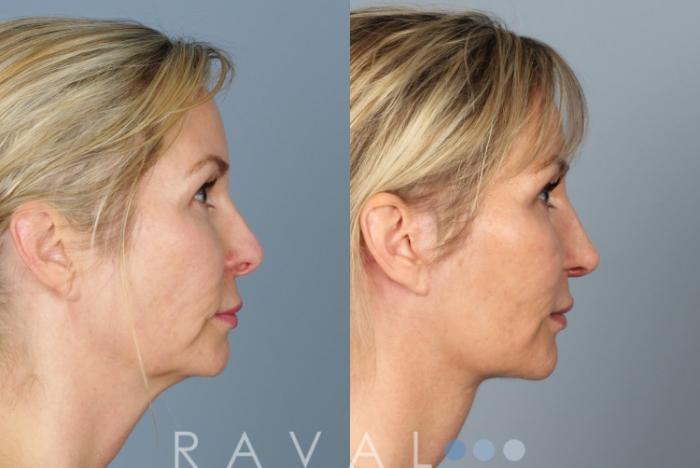 Before & After Revision Rhinoplasty Case 1046 View 2 View in Denver, CO