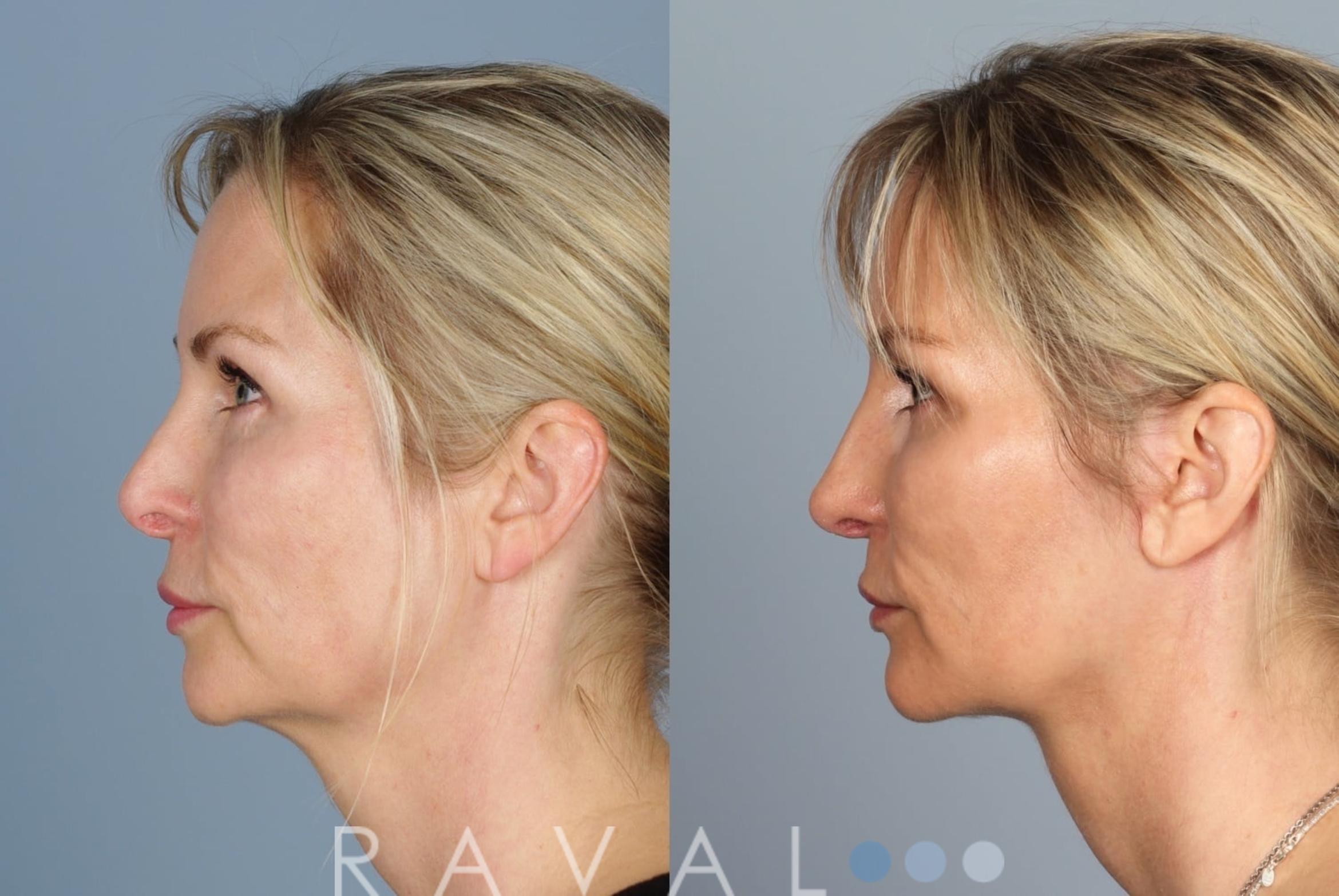 Before & After Revision Rhinoplasty Case 1046 View 3 View in Denver, CO