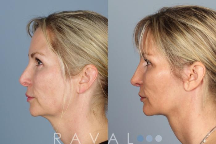 Before & After Revision Rhinoplasty Case 1046 View 3 View in Denver, CO