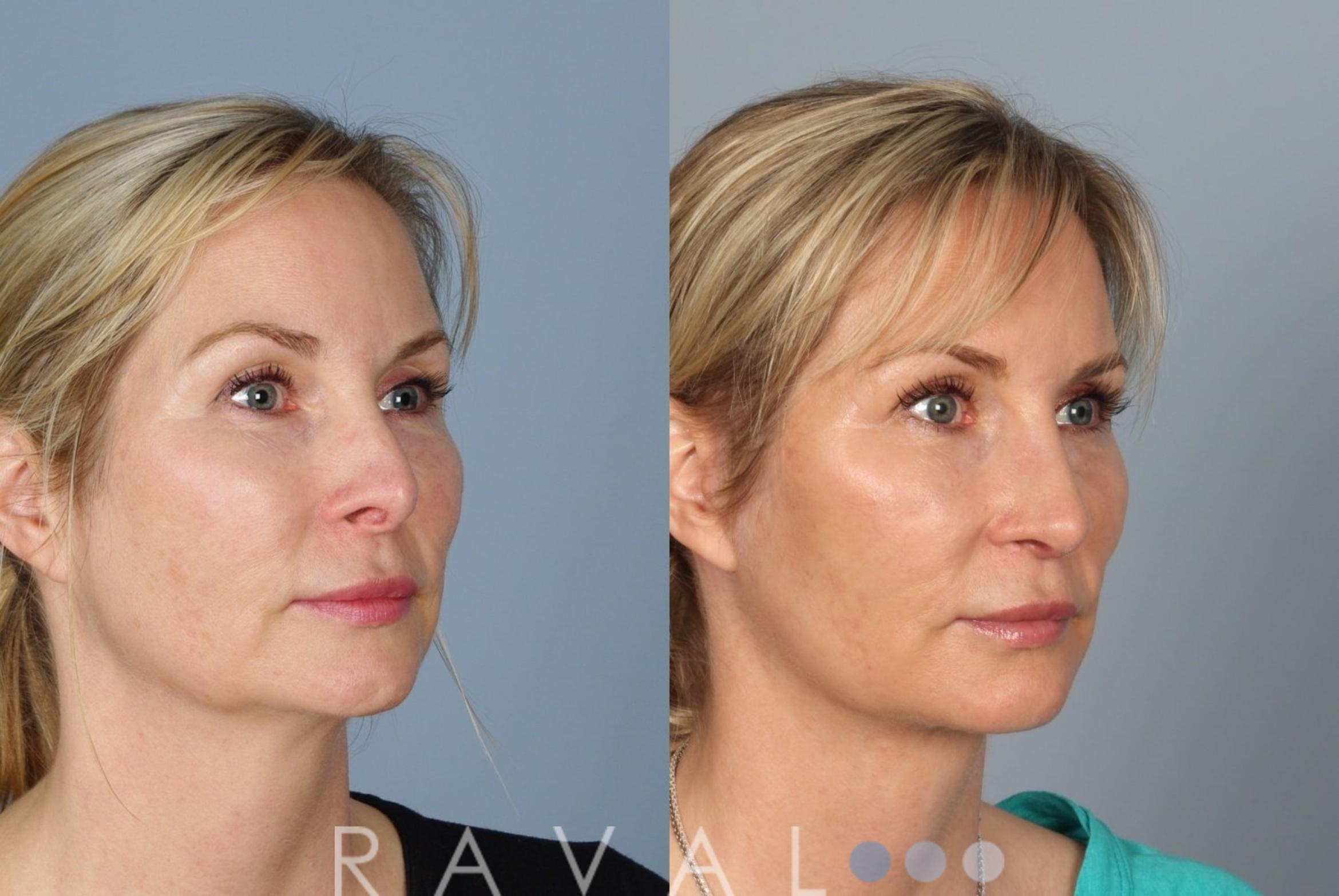Before & After Revision Rhinoplasty Case 1046 View 4 View in Denver, CO